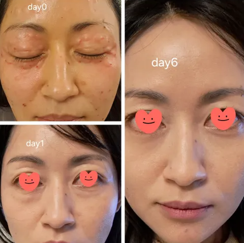 Rejuran I, 1x1ml - Image 8